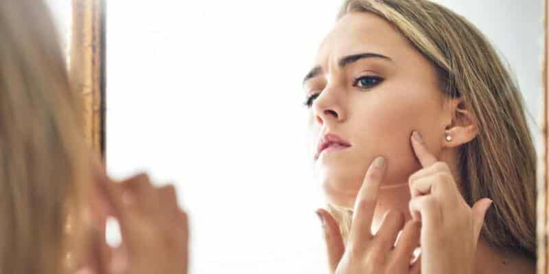 Akneye Neden Olabilecek 7 Beslenme Alışkanlığı!