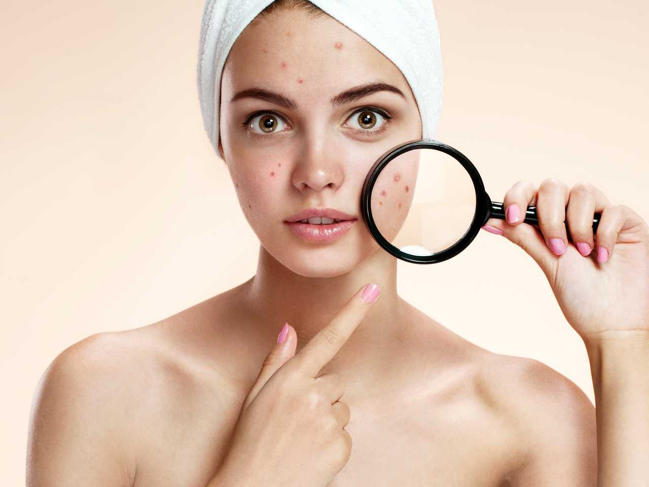 Sivilce Oluşumunu Önlemek İçin Neler Yapılmalı?