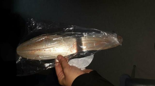 Hastanın Karnında Mala Unuttular!