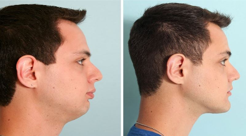 Son Dönemin Popüler Estetiği Jawline Nedir?