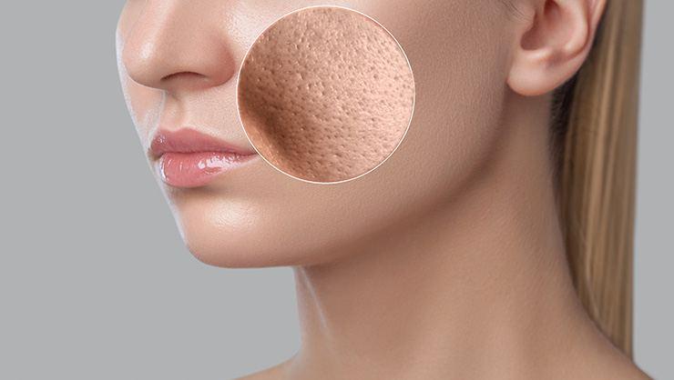 Gözenek Sıkılaştırıcı Doğal Maske Tarifleri