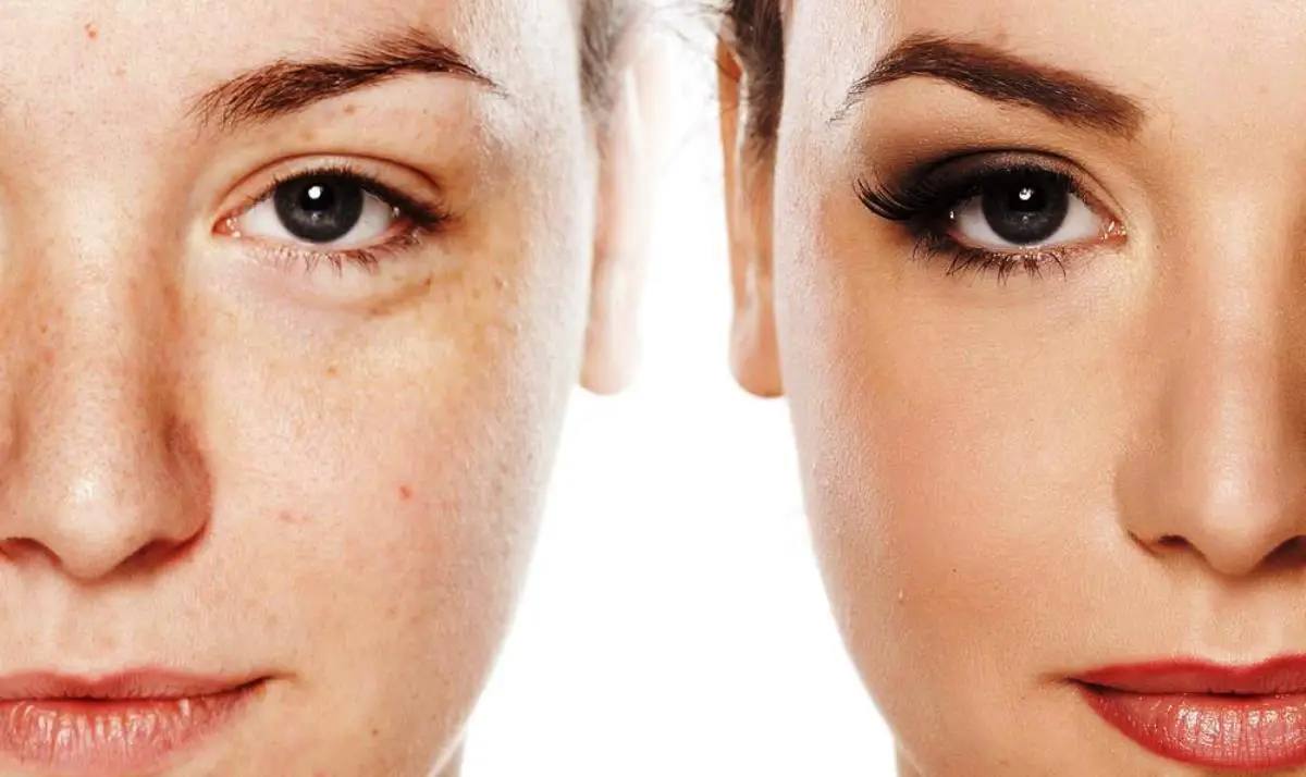 Gençleşmek İsteyenlerin Tercihi: Altın İğne Tedavisi