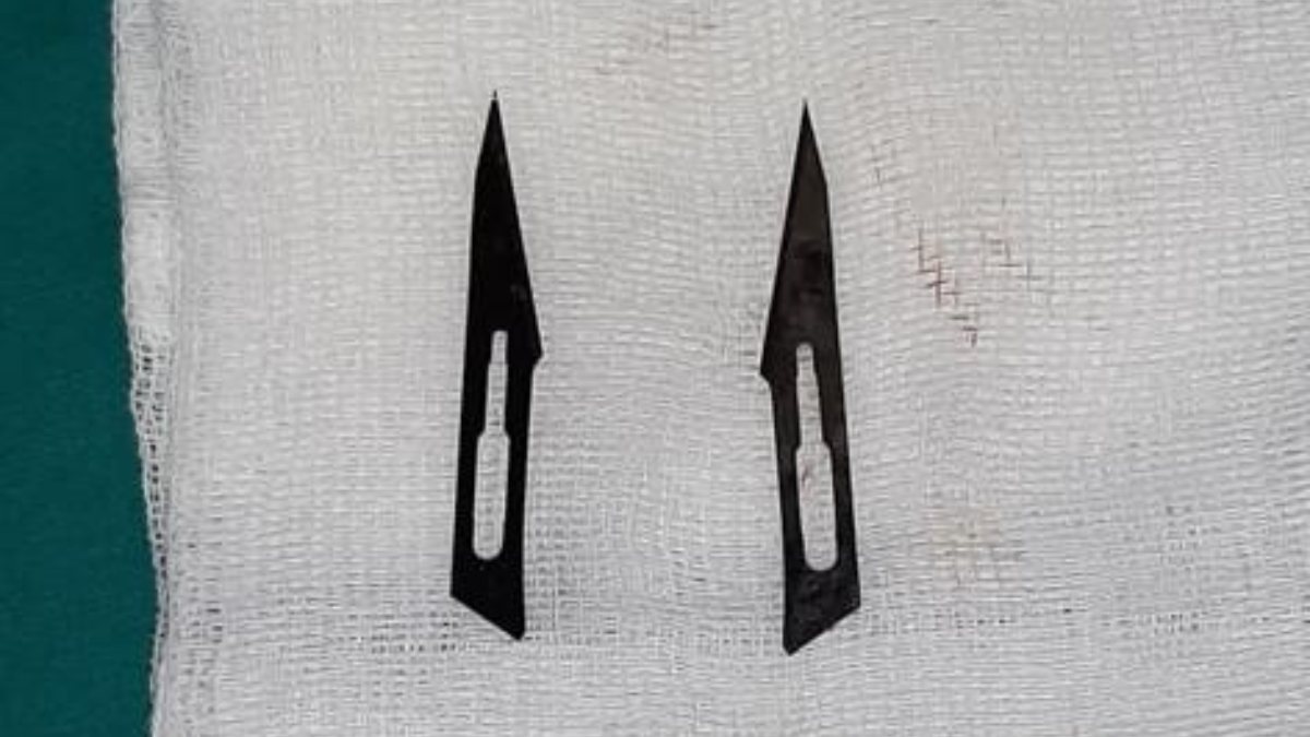 Karın Ağrısı Şikayetiyle Doktora Giden Kadının Midesinden Neşter Çıkarıldı