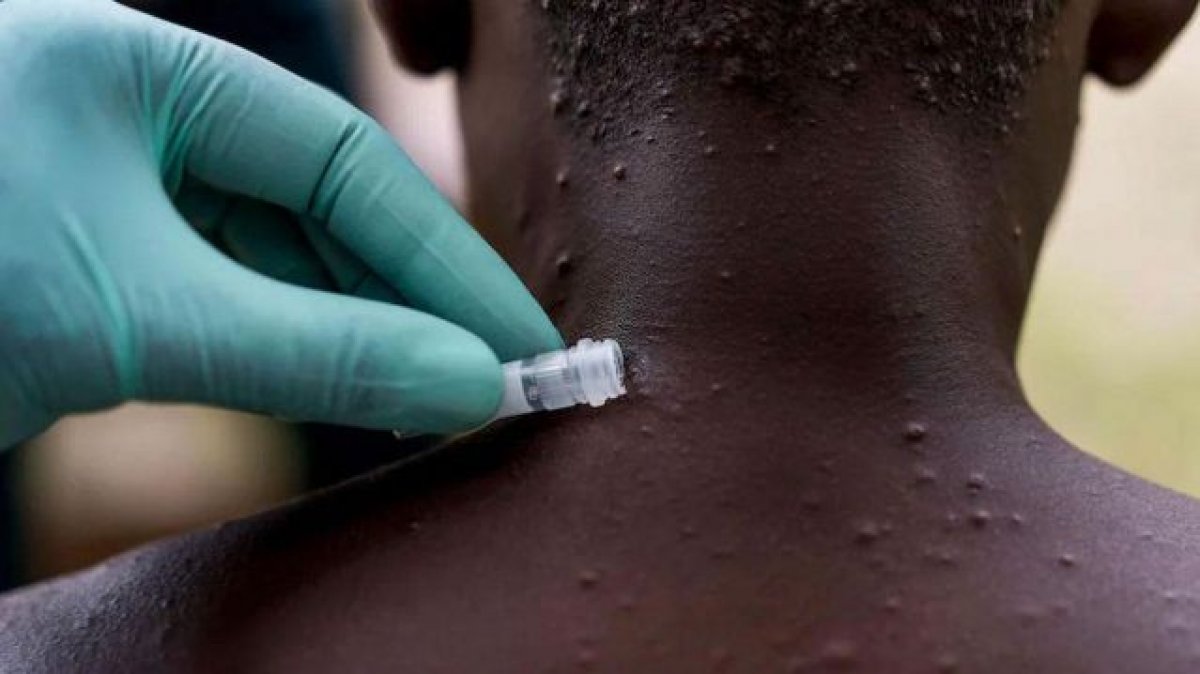 Maymun Çiçeği Kaynaklı İlk Ölüm Haberi Afrika’dan Geldi!