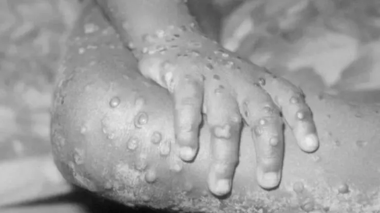 İngiltere’den Maymun Çiçeği Uyarısı: Cinsel İlişkiye Girmeyin