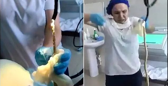 Genç Kadının Midesinden Yılan Çıktı