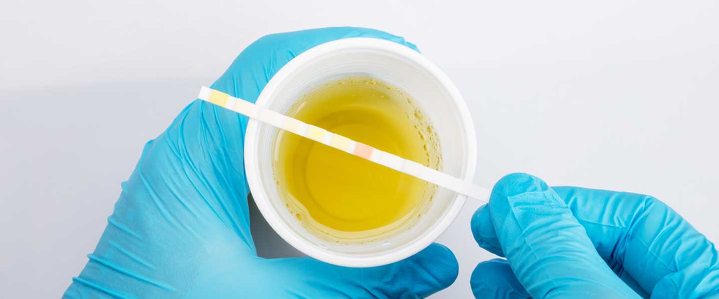 UREA Üre Nedir? Üre Yüksekliği ve Düşüklüğü Nedir?