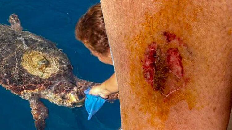 Göcek Sahili Açıklarında Yüzen Kadını Deniz Kaplumbağası Isırdı