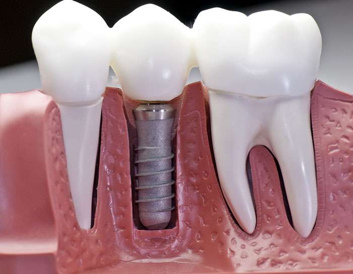 Diş Tedavisinde İmplant İşlemi Nedir? Nasıl Yapılır?