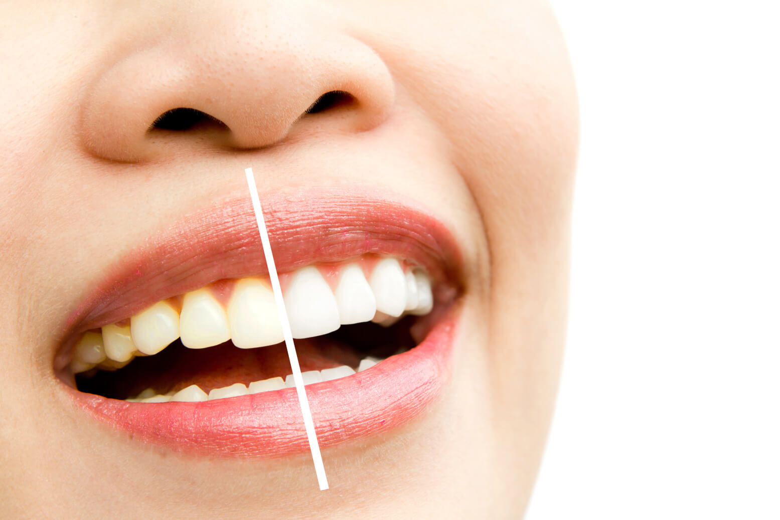 Sararmış Dişlere 9 Doğal Tedavi Yöntemi