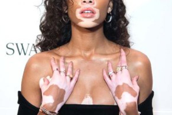 Vitiligo Hastalığı Nedir? Bu Deri Hastalığı Kişiyi Nasıl Etkiler?