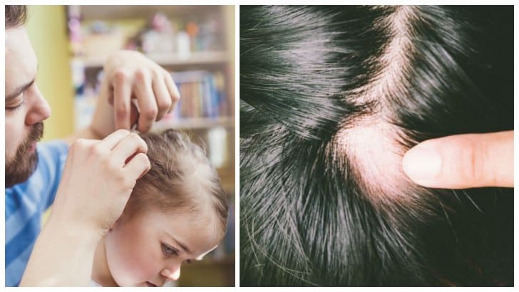 Erkek, Kadın ve Çocuklarda Görülen Saç Dökülme Nedenleri ve Tedavisi