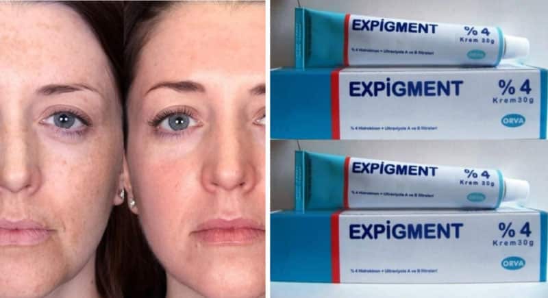 Expigment Krem Nedir, Ne İşe Yarar?