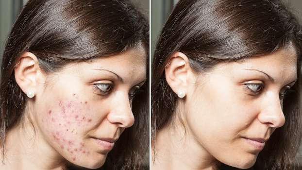 Retinol Nedir? Retinol’ün Faydaları Nelerdir?