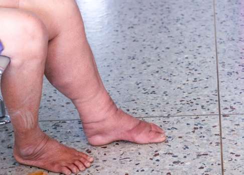 Fil Ayağı Hastalığı Nedir, Belirtiler Nelerdir?