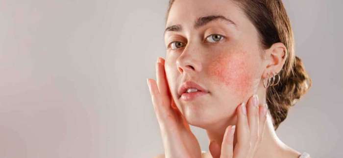 Gül Hastalığı Nedir? Gül Hastalığı Belirtileri...