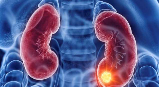 Ürolog Karabay’dan Uyarı; Böbrek Kanserine Dikkat!