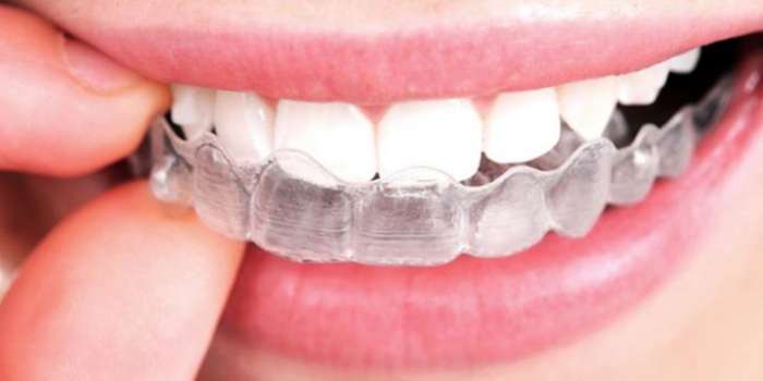 Ortodonti Nedir? Ortodonti Neye Bakar? Ortodonti Tedavisi…