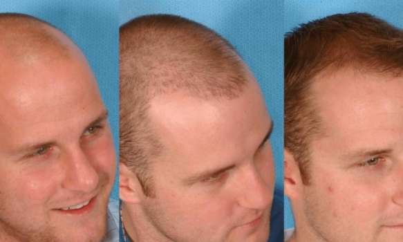 Saç Ekimi Nedir? Saç Ekimi Zararlı mı? 2023 Saç Ekimi Fiyatları