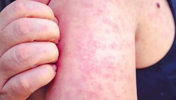 Sağlık Bakanlığından 81 İlde Kızamık Uyarısı!