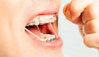 2023 Diş Teli Fiyatları Ne Kadar? Şeffaf Plak,  Metal Diş Teli…