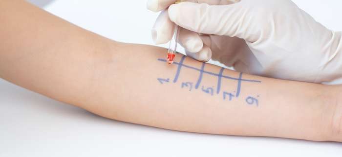 Alerji Testi Nedir? Alerji Testi Nerede Yaptırılır?