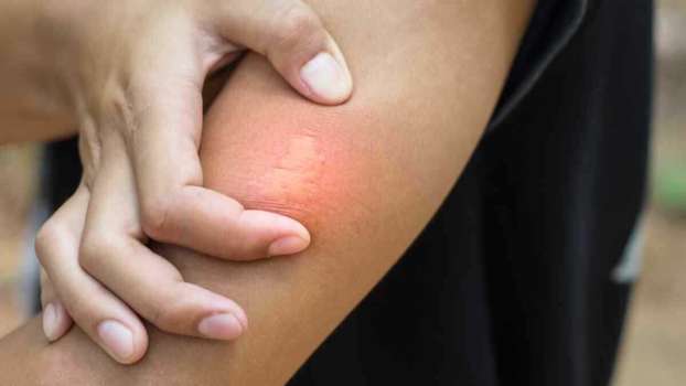 Çocuklarda Arı Sokması; Arı İğnesi Vücutta Kalır Mı?