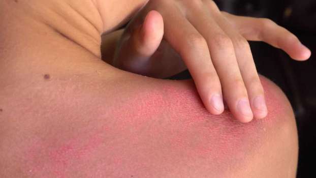 Güneş Yanığına Ne İyi Gelir? Güneş Yanığı Nasıl Geçer?