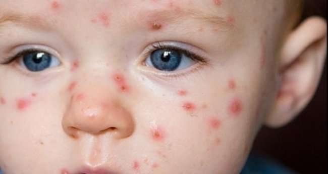 Kızamık Nedir? Kızamık Belirtileri Nelerdir? Kızamık Nasıldır?