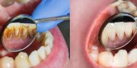 Diş Taşı Temizliği Nedir? Diş Taşı Temizliği Nasıl Yapılır?