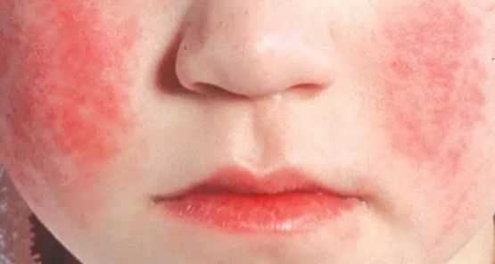 Çocuklar Arasında Çok Yaygın Olan ''Beşinci Hastalık Parvovirüs B19'' Konusunda Uzmanlardan Uyarı!