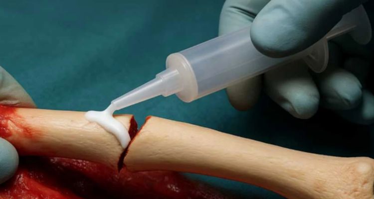 Kırık Kemikler İçin Yeni Çare: Kırık Kemik Yapıştırıcı Tabancası