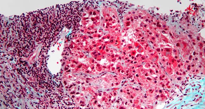 XJ-4-85 Nedir? Fare Deneylerinde Tümörleri Küçülten Molekül
